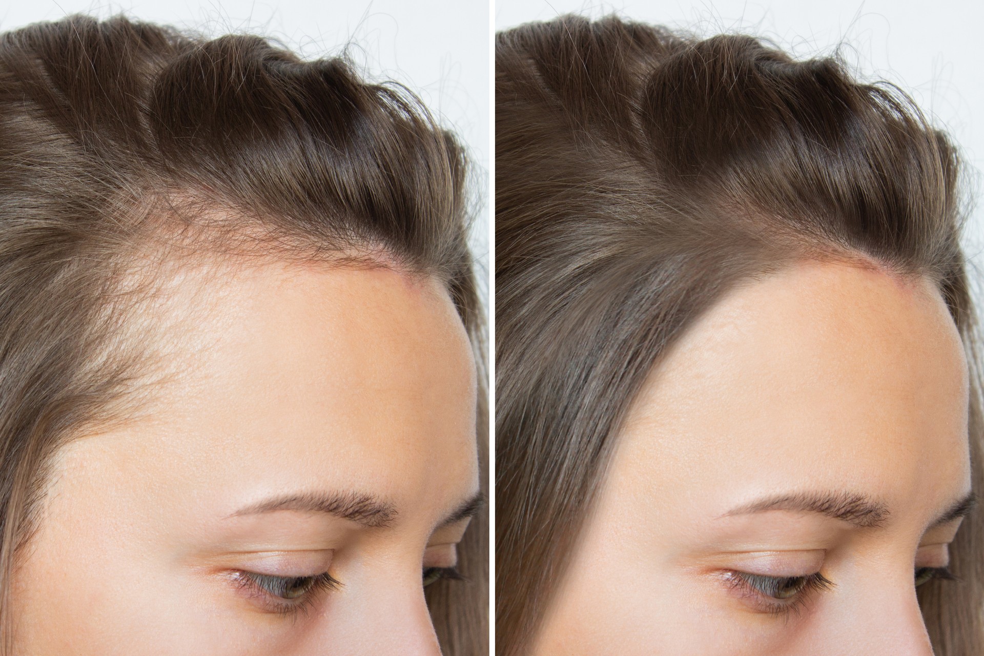 Cropped before and after head shot of a young woman with bald patches on her forehead and temples